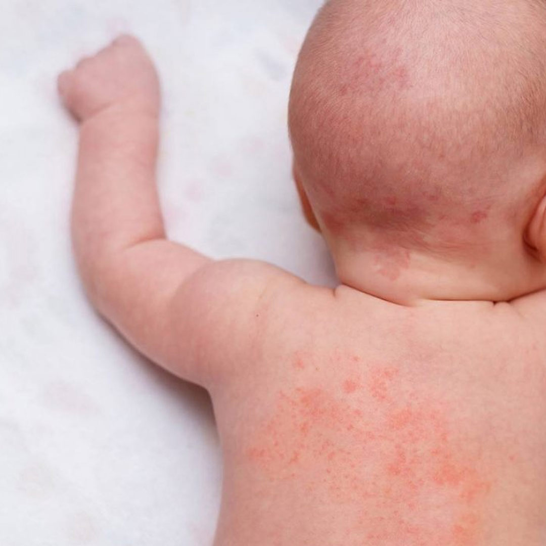 Nappy Rash available in online  pharmacy qatar, doha 